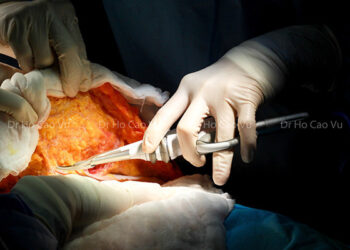 Bác sĩ chia sẻ lưu ý khi cùng lúc phẫu thuật tạo hình thành bụng, nâng ngực