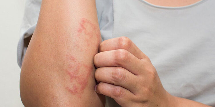 6 sai lầm khiến da nứt nẻ, gây ngứa vào ngày lạnh